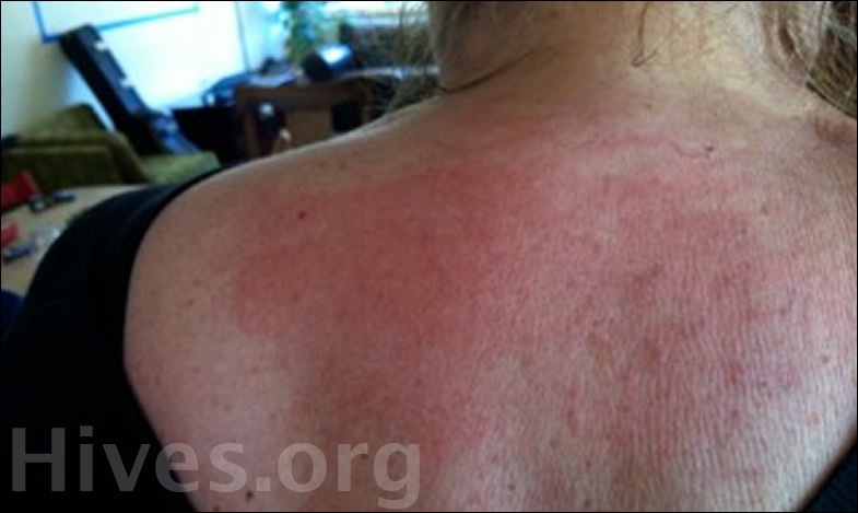 Hives Rash On Back