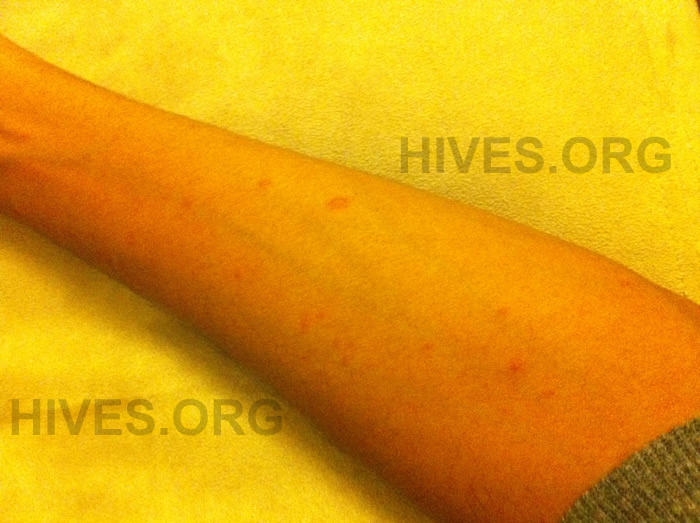 hives on arms picture