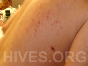 hives on back
